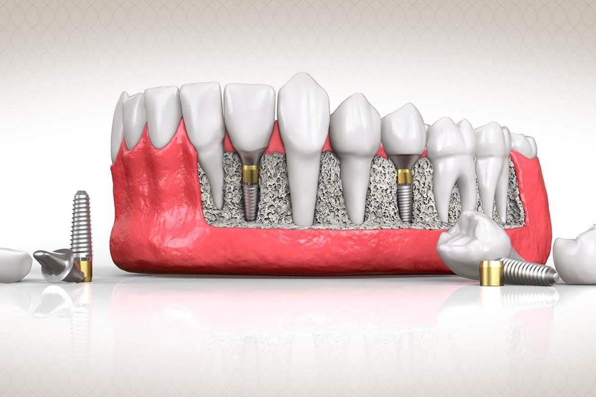 زراعة الاسنان