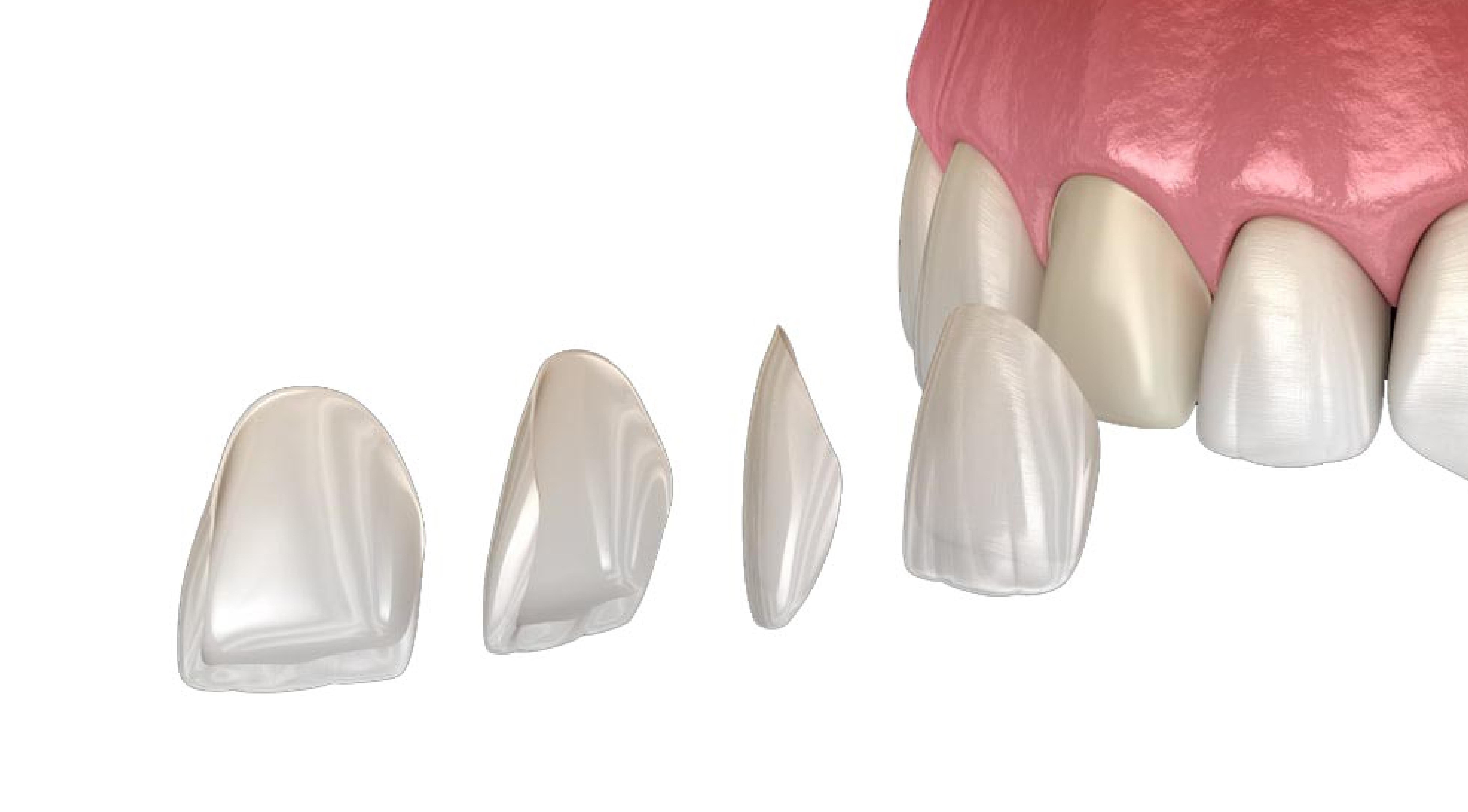 قشور خزفية رقمية